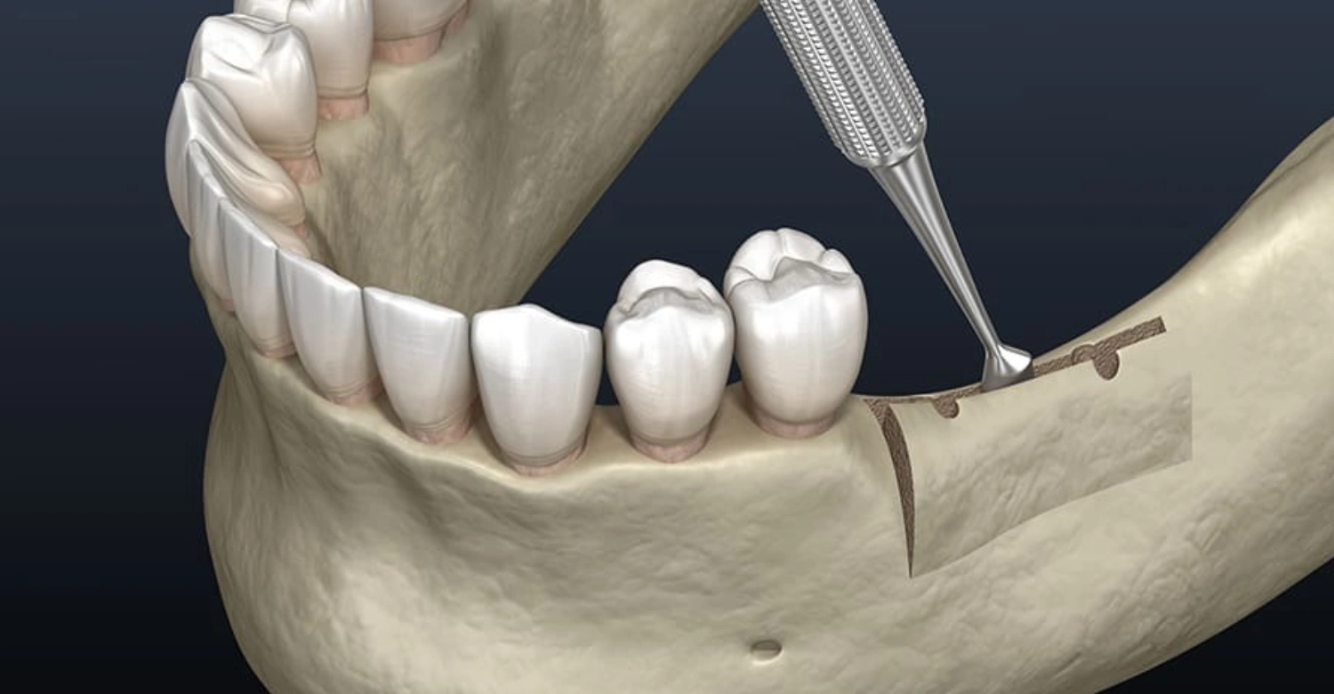Alveoloplasty In blog